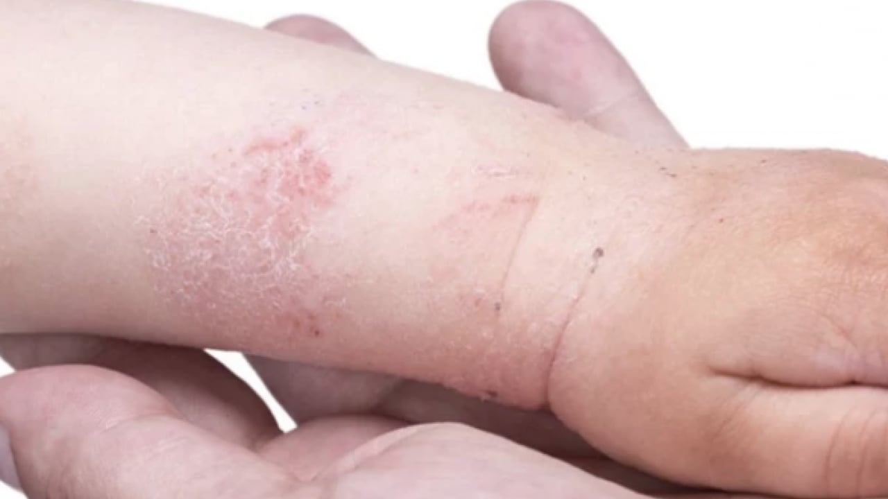 Foto - Egzamaya, ayak mantarına, cilt kuruluğuna şifa kaynağı! Ayakları 5 dakikada bebek gibi yapıyor