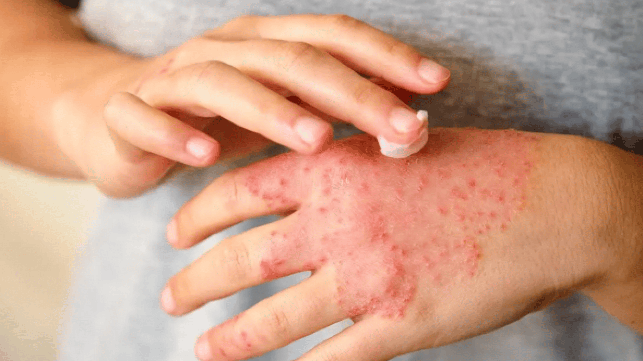 Egzamaya iyi geliyor diye sürülüyor: Meğer cilde çok zarar veriyormuş!