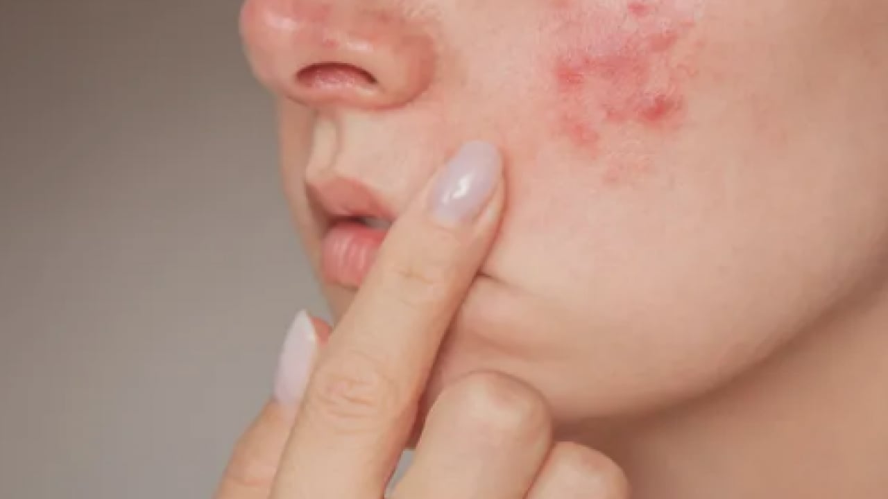 Foto - En can sıkıcı boyutu: 1 günde sivilceyi yok ediyor! Doğal çözüm arayanlar buraya...