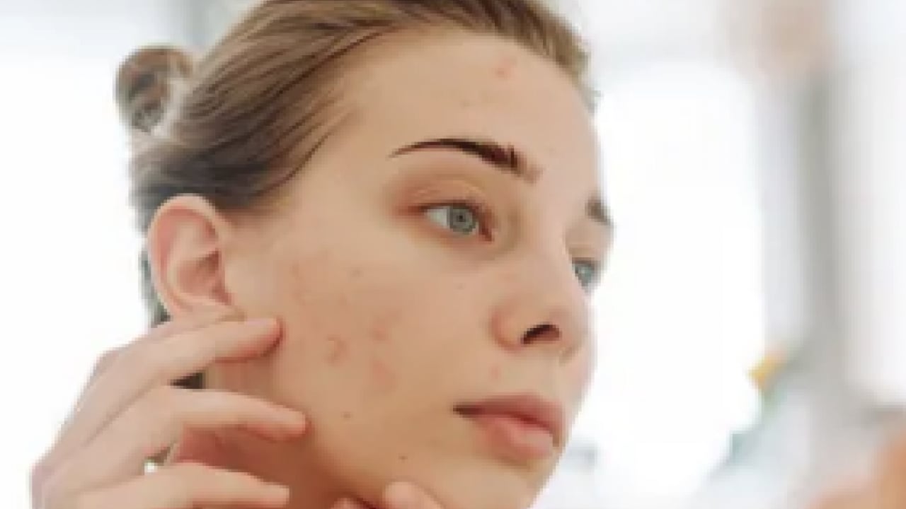 Foto - En can sıkıcı boyutu: 1 günde sivilceyi yok ediyor! Doğal çözüm arayanlar buraya...