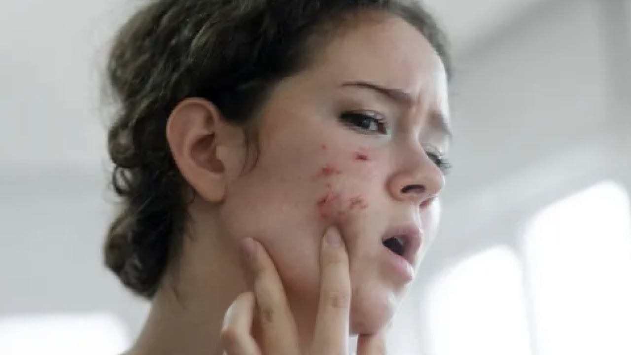 Foto - En can sıkıcı boyutu: 1 günde sivilceyi yok ediyor! Doğal çözüm arayanlar buraya...