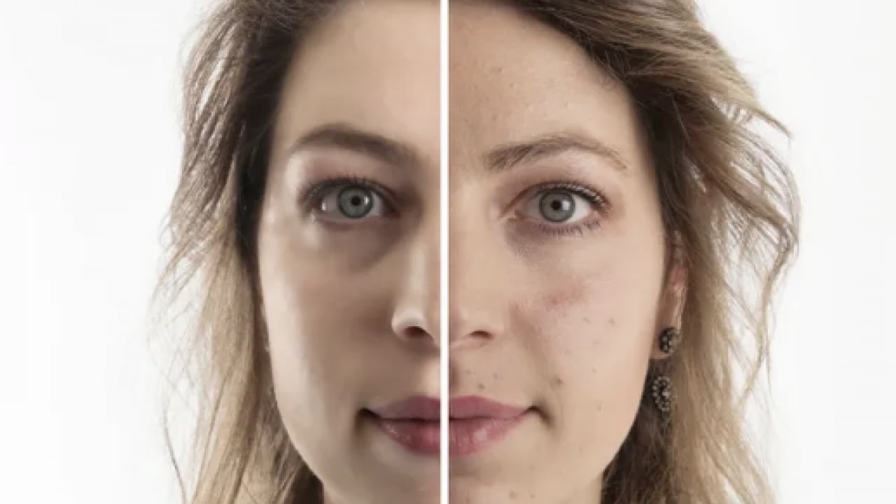 Foto - En can sıkıcı boyutu: 1 günde sivilceyi yok ediyor! Doğal çözüm arayanlar buraya...