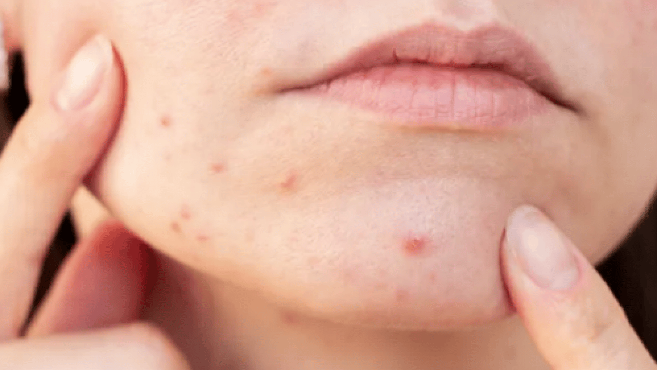 En can sıkıcı boyutu: 1 günde sivilceyi yok ediyor! Doğal çözüm arayanlar buraya...