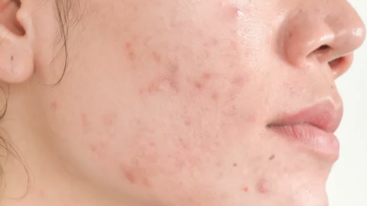 Foto - En can sıkıcı boyutu: 1 günde sivilceyi yok ediyor! Doğal çözüm arayanlar buraya...