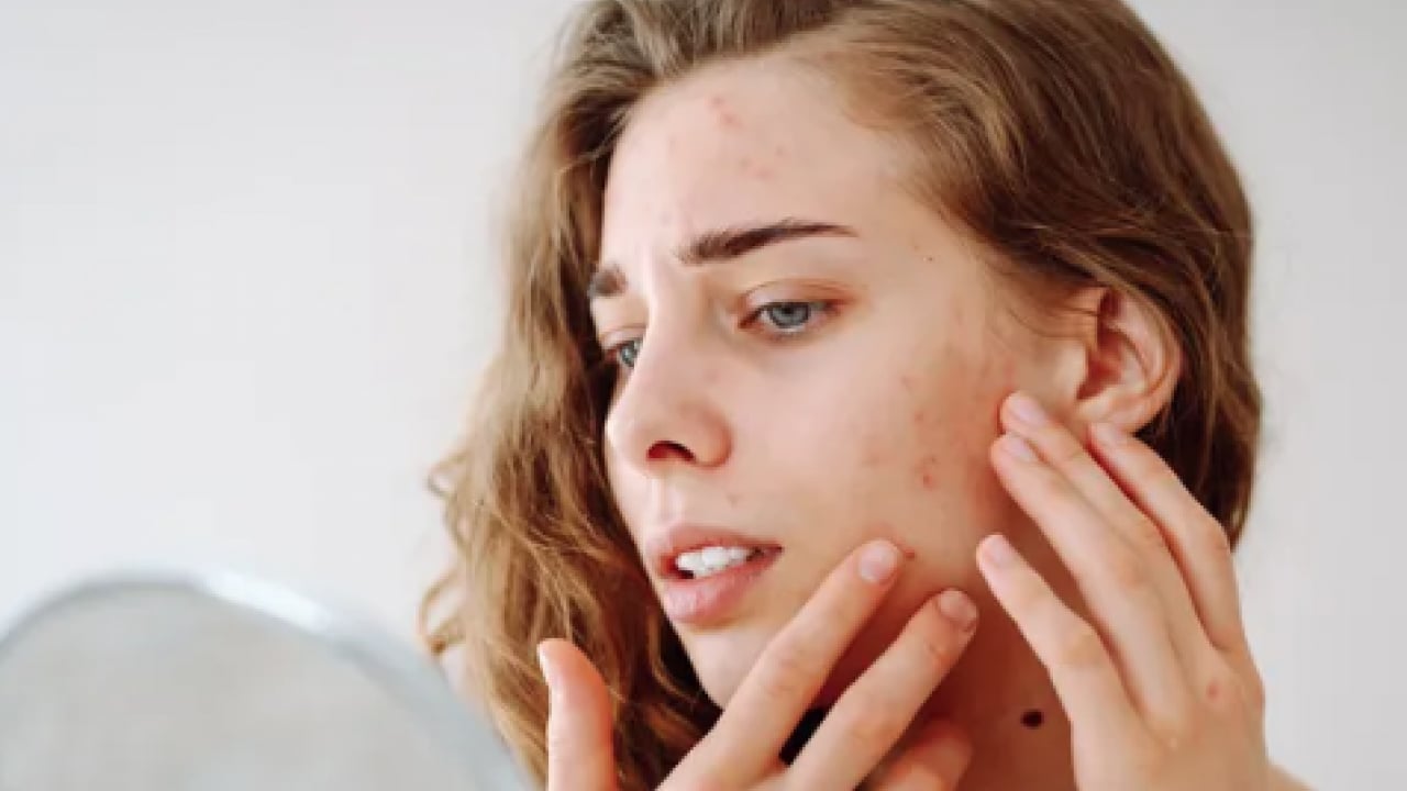 Foto - En can sıkıcı boyutu: 1 günde sivilceyi yok ediyor! Doğal çözüm arayanlar buraya...