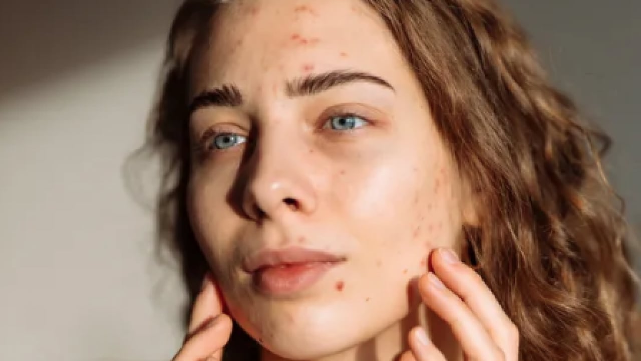 Foto - En can sıkıcı boyutu: 1 günde sivilceyi yok ediyor! Doğal çözüm arayanlar buraya...