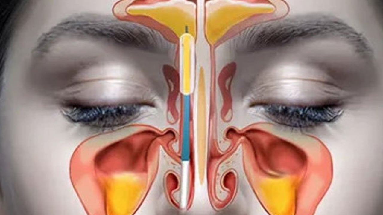 En iyi yöntem nane yağı: Tıkalı sinüsleri anında boşaltıyor! Bu yağ, sinüzit için binlerce yıldır evlerde sıkça kullanılıyordu