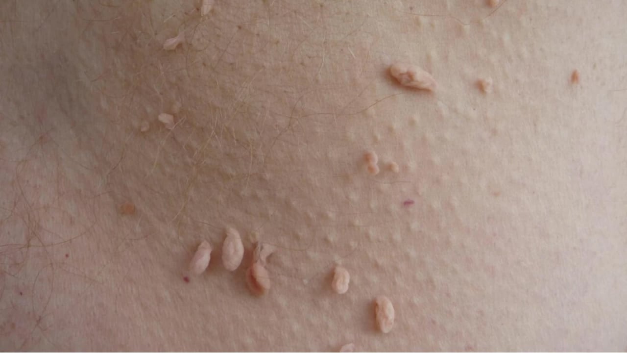 Et benlerini patır patır düşüren gizli kür tarifi Prof. Dr. İbrahim Saraçoğlu verdi: Haftada 2 kez kullanın diyor, önerisi bu