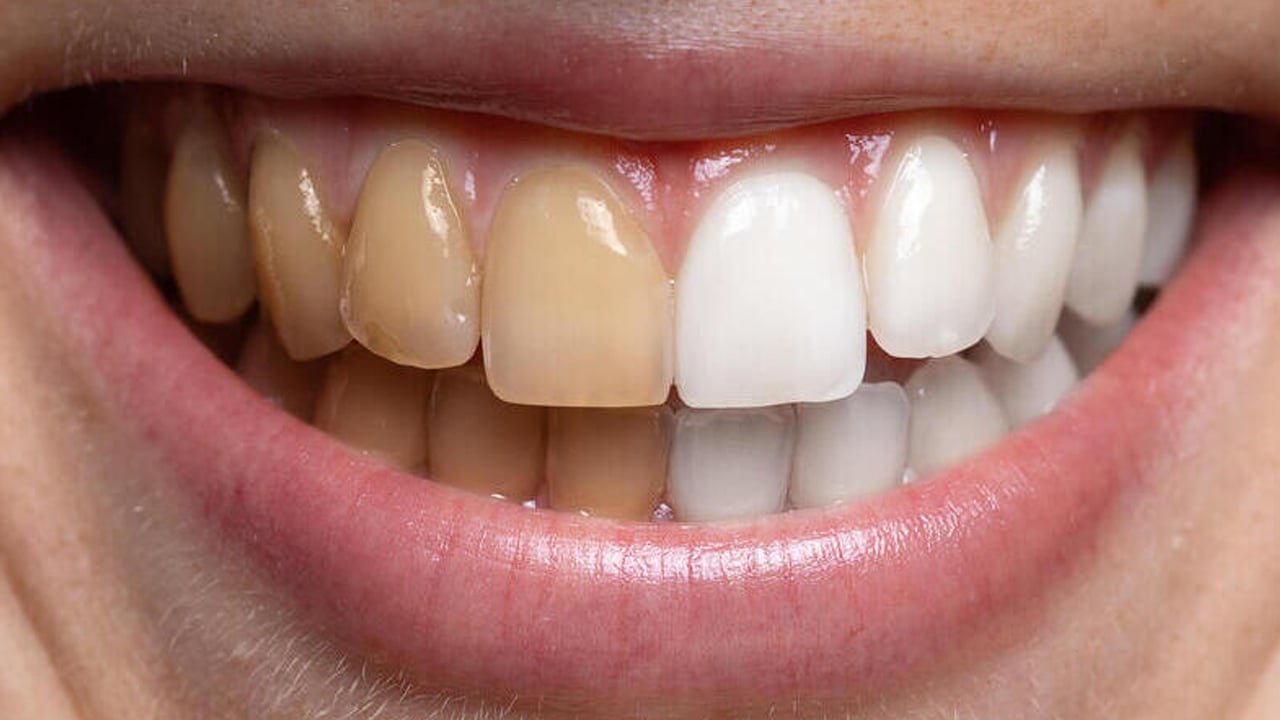 Diş için çay ve kahve büyük bir tehlike! Diş tartarı nasıl temizlenir?