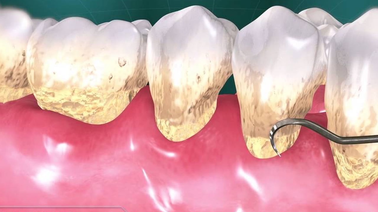 Evde tartar lekelerinden nasıl kurtulursunuz? Sararan dişleri anında beyazlatan doğal yöntem: Kar tanesinde bile beyaz oluyor