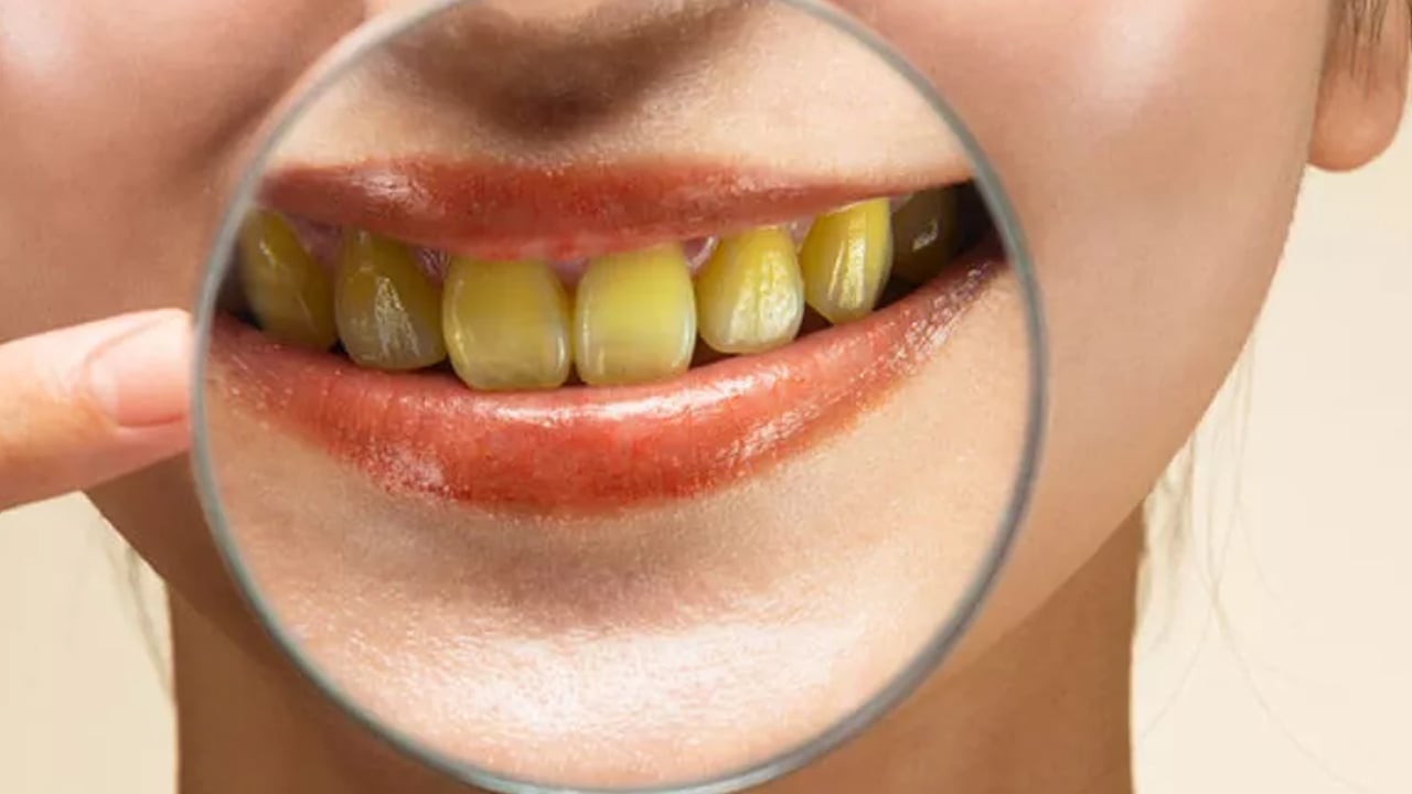 Foto - Evde tartar lekelerinden nasıl kurtulursunuz? Sararan dişleri anında beyazlatan doğal yöntem: Kar tanesinde bile beyaz oluyor