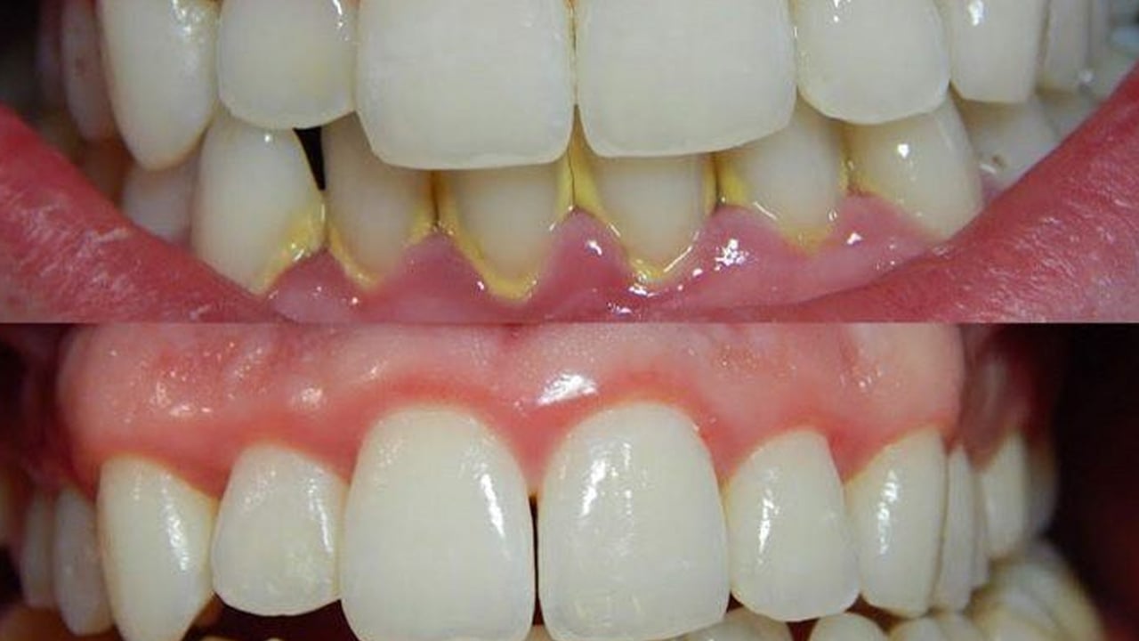 Foto - Evde tartar lekelerinden nasıl kurtulursunuz? Sararan dişleri anında beyazlatan doğal yöntem: Kar tanesinde bile beyaz oluyor