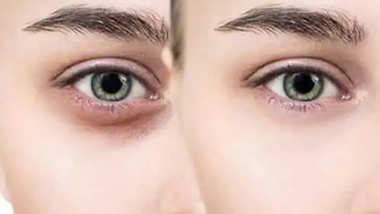 Foto - Göz altı morluklarına sır gibi saklanan mucizevi çözüm: Bebek gibi cildin sırrı! Kolejen etkisini birçok kişi bilmiyor