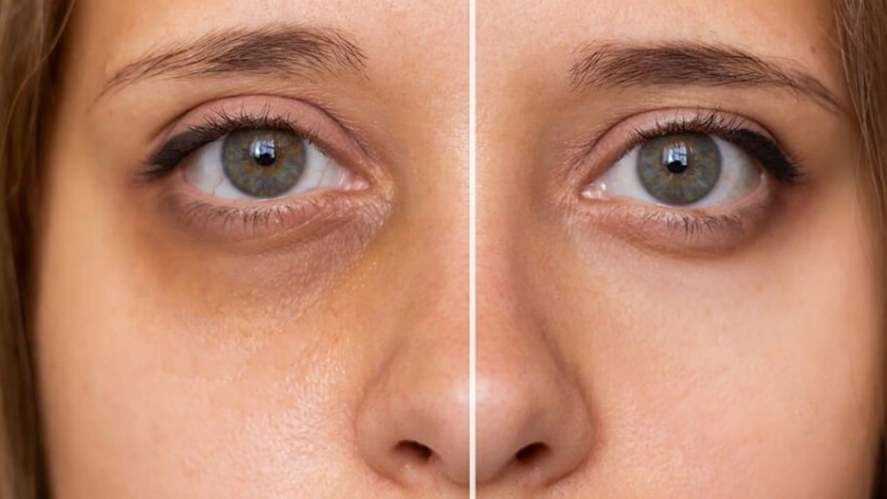 Foto - Göz altı morluklarına sır gibi saklanan mucizevi çözüm: Bebek gibi cildin sırrı! Kolejen etkisini birçok kişi bilmiyor