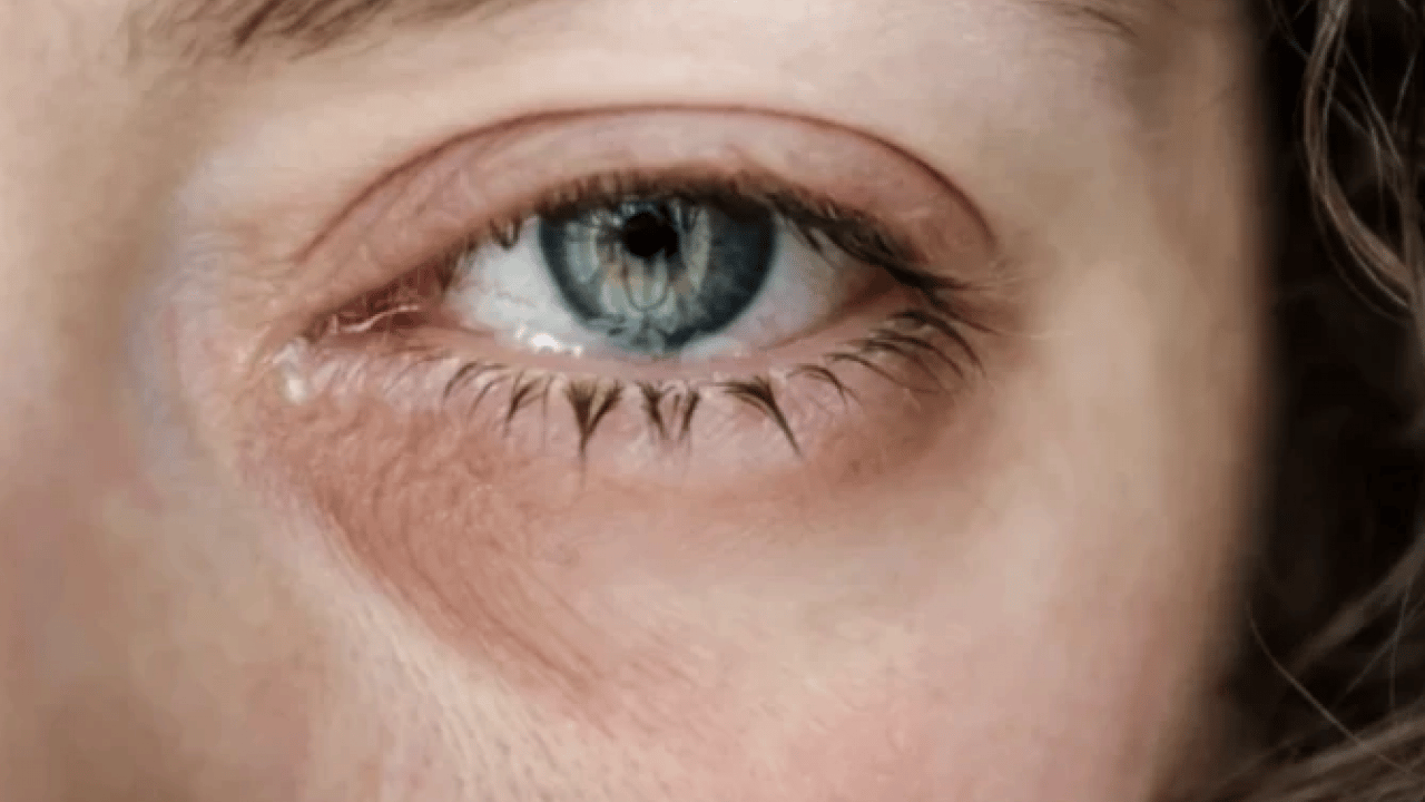 Foto - Gözde kaşıntıyı hafife almayın! Bu hastalığın habercisi olabilir