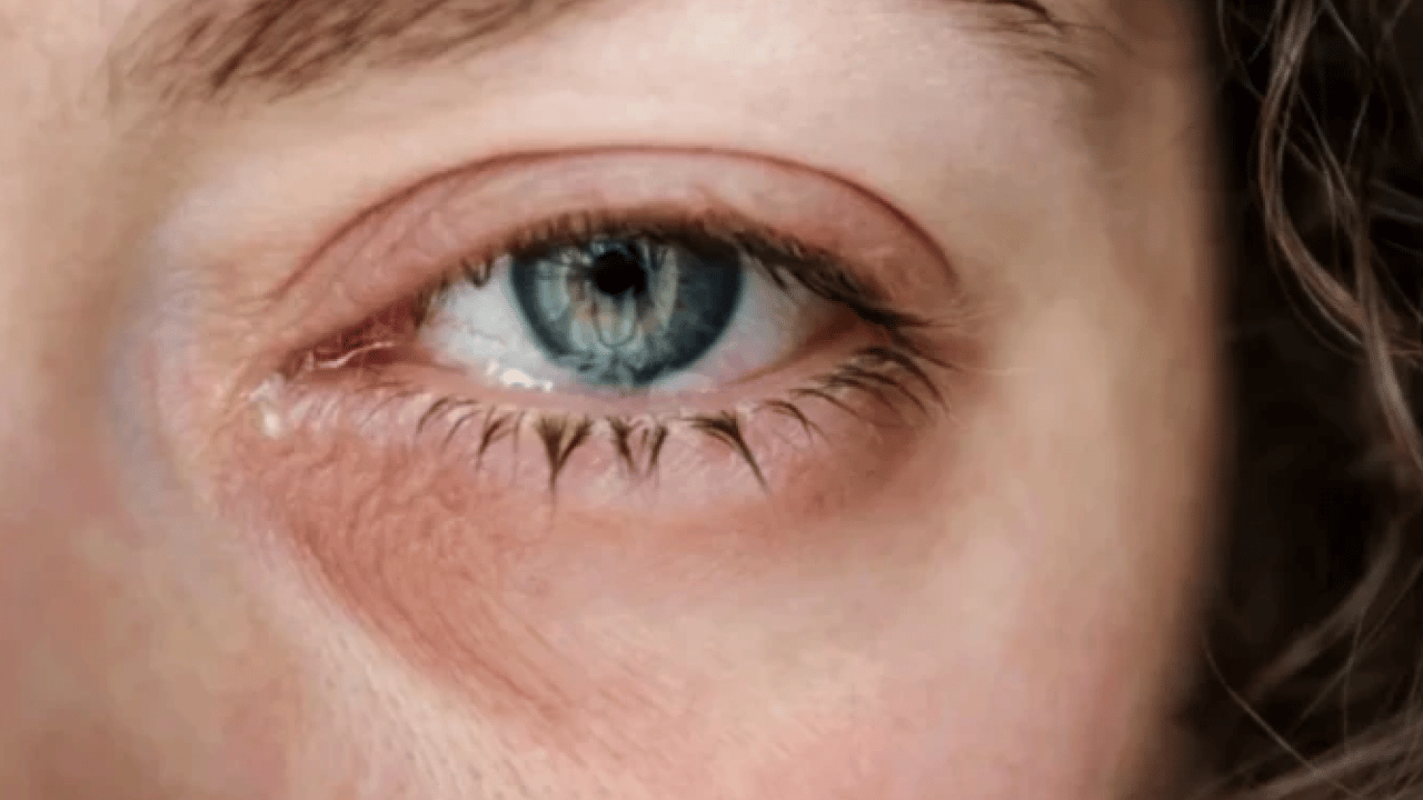 Gözde kaşıntıyı hafife almayın! Bu hastalığın habercisi olabilir