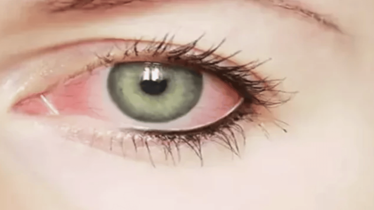 Foto - Gözde kaşıntıyı hafife almayın! Bu hastalığın habercisi olabilir