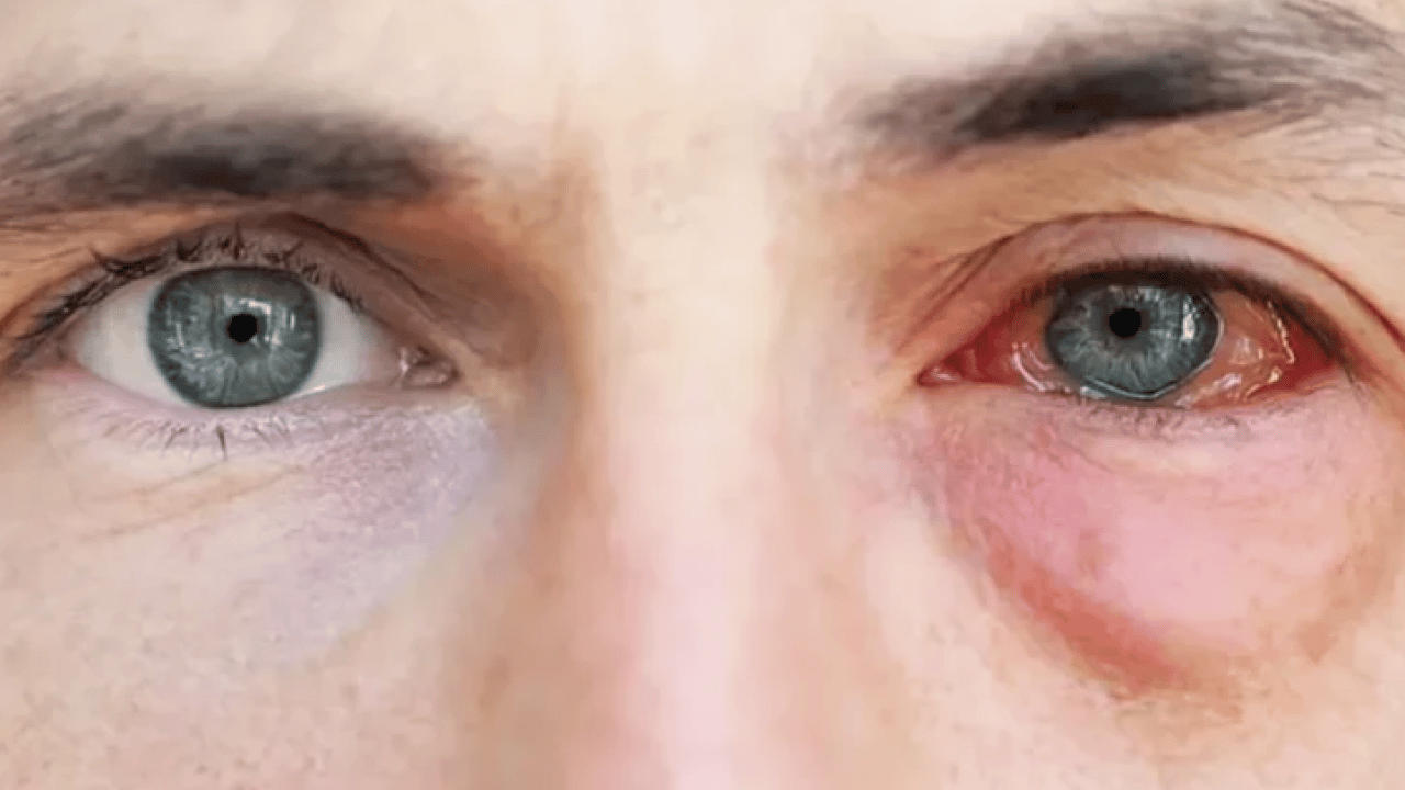 Foto - Gözde kaşıntıyı hafife almayın! Bu hastalığın habercisi olabilir