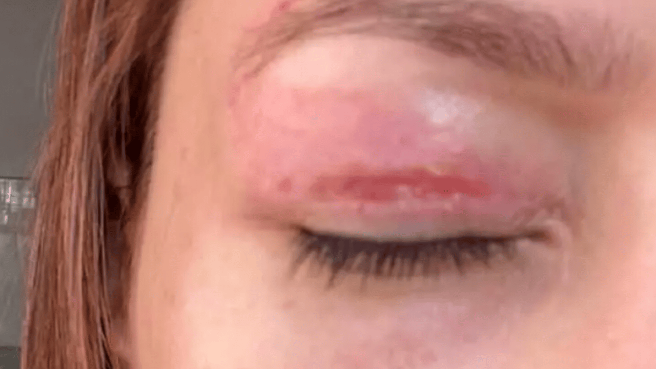 Foto - Gözlerinde kalıcı hasar oluştu! Mahkemeden gelen karar şok etti!