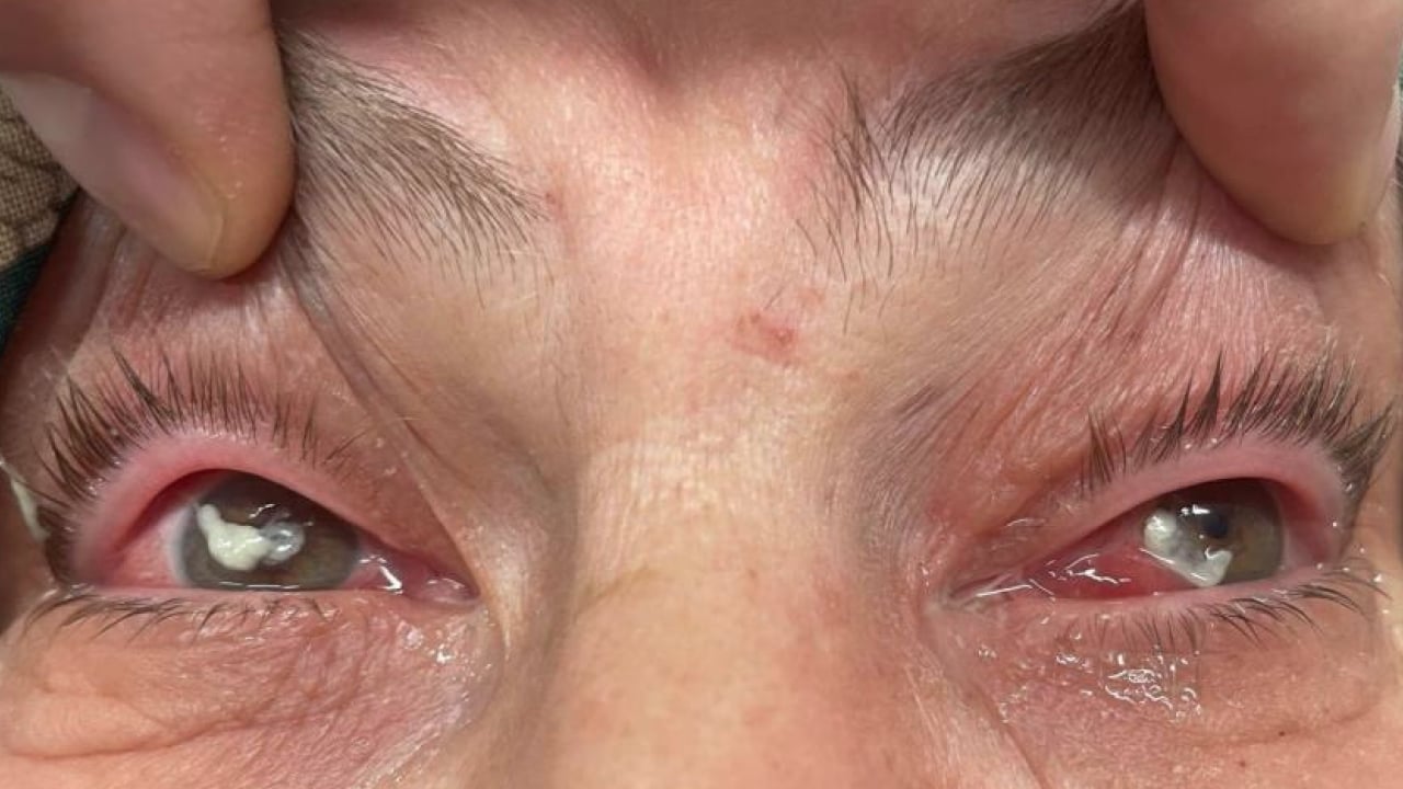 Foto - Gözlerine suyunu damlattı, göremez hale geldi... Kötü haber geldi! Tamamen tahrip ediyor...