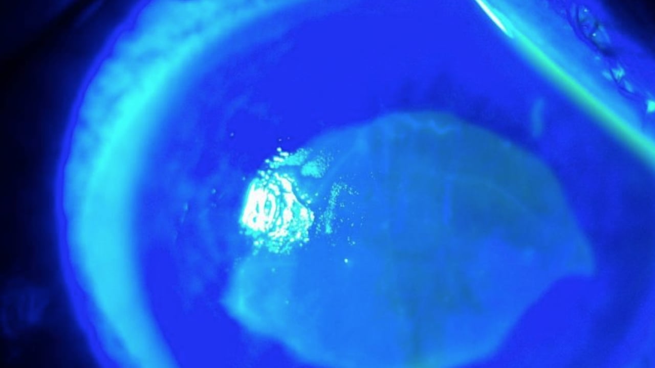 Foto - Gözlerine suyunu damlattı, göremez hale geldi... Kötü haber geldi! Tamamen tahrip ediyor...