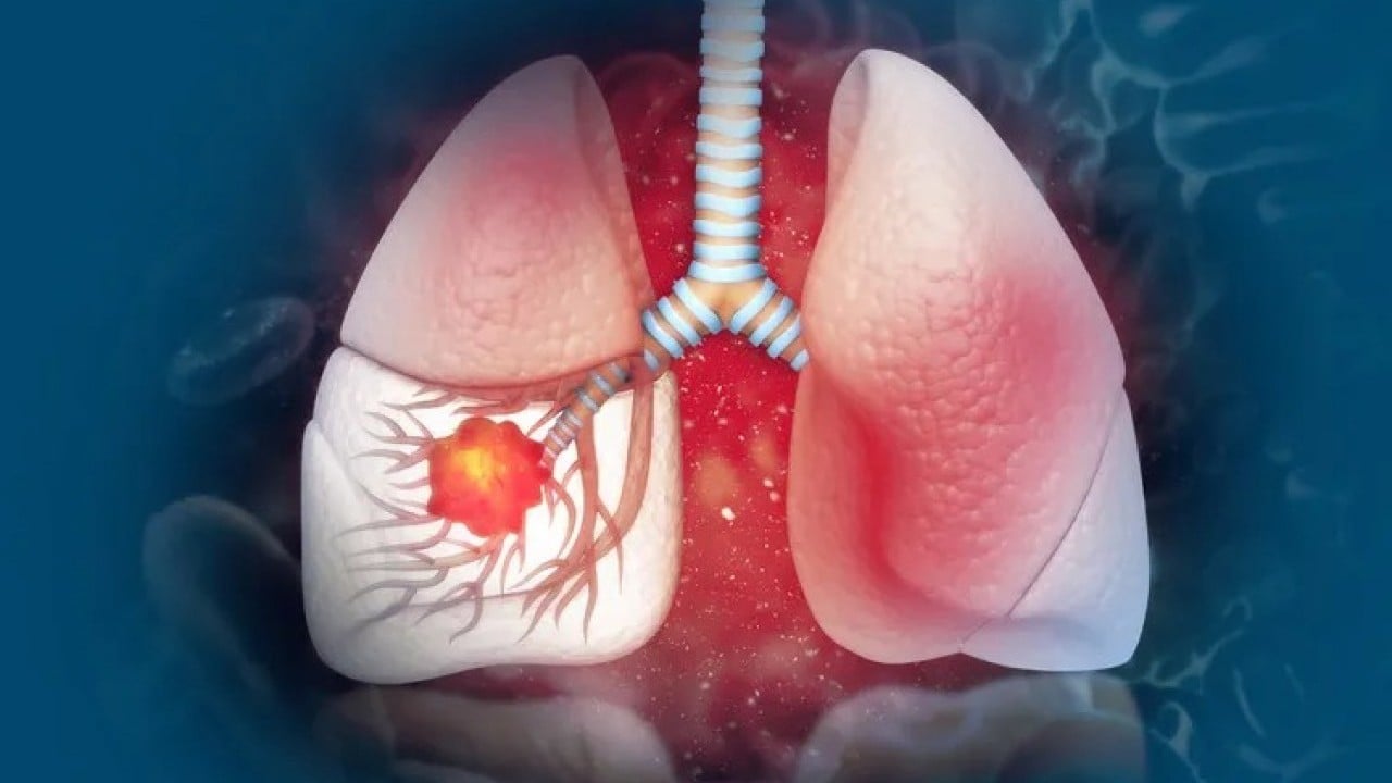 Foto - Gözlerinizi açtığınızda vücudunuz size bu sinyali veriyor olabilir! Akciğer kanserinin sabahları fark edilen o gizli işareti ortaya çıktı!