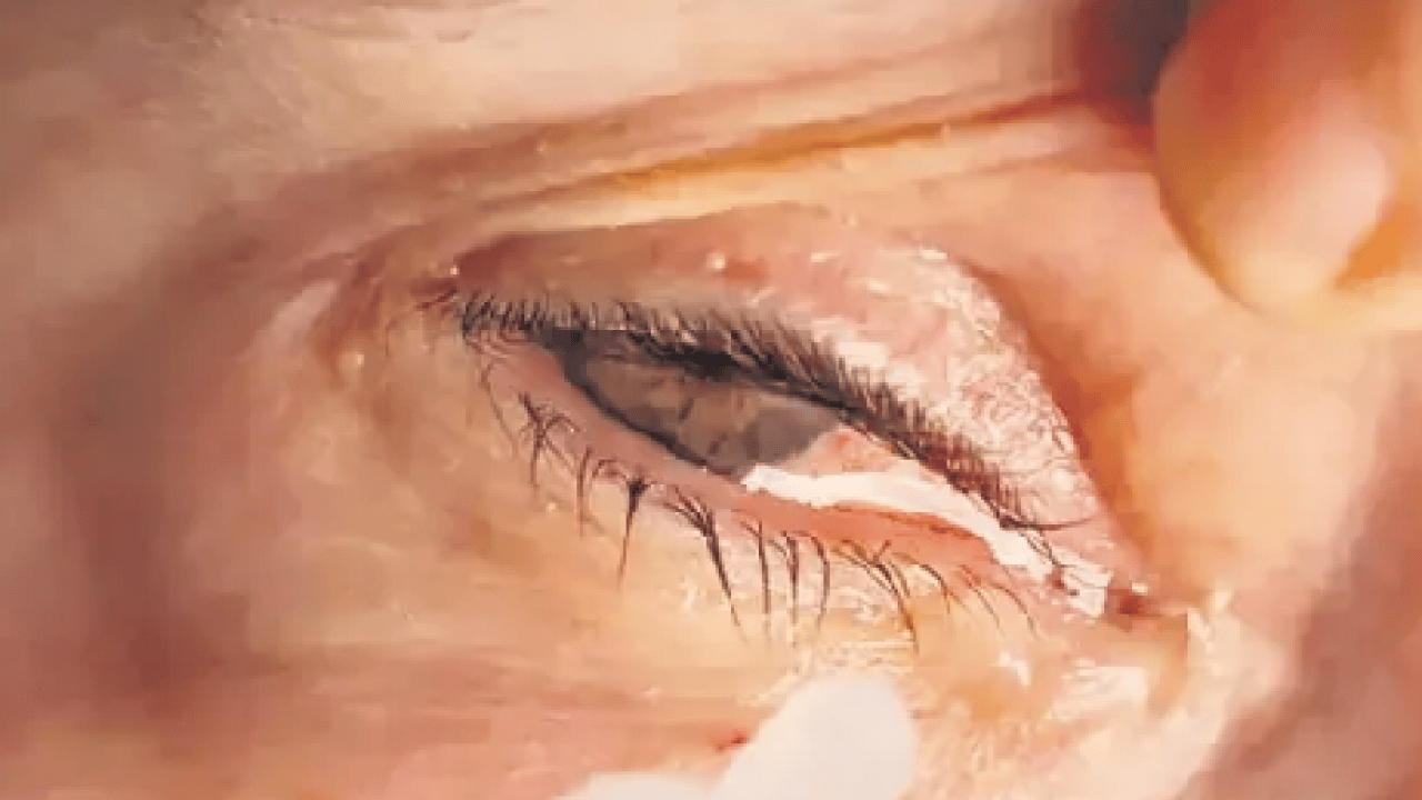 Foto - Gözlerinizi ovuştururken bir kez daha düşünün! Körlüğe davetiye çıkarıyor...