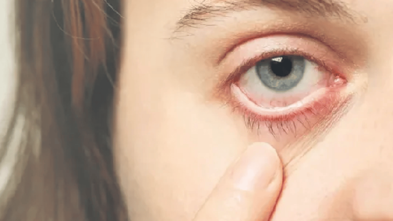 Foto - Gözlerinizi ovuştururken bir kez daha düşünün! Körlüğe davetiye çıkarıyor...