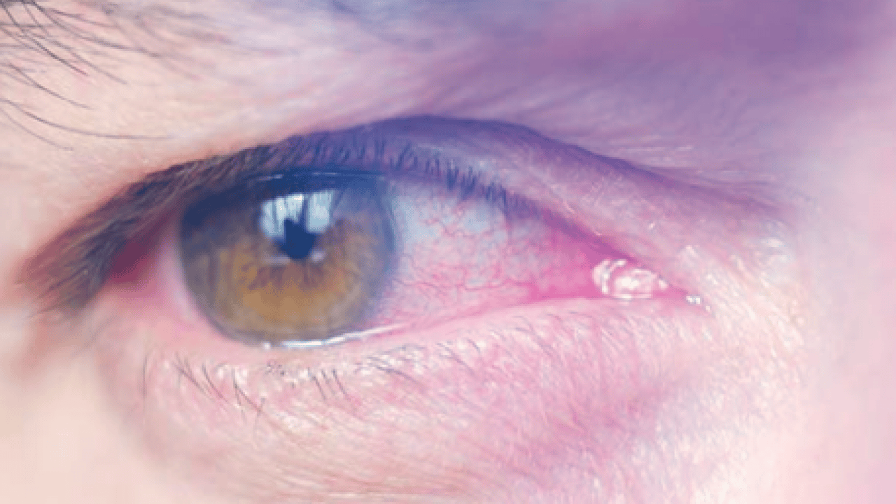 Gözün ‘sessiz hırsızı’ Glokom: Fark ettiğinizde çok geç olabilir