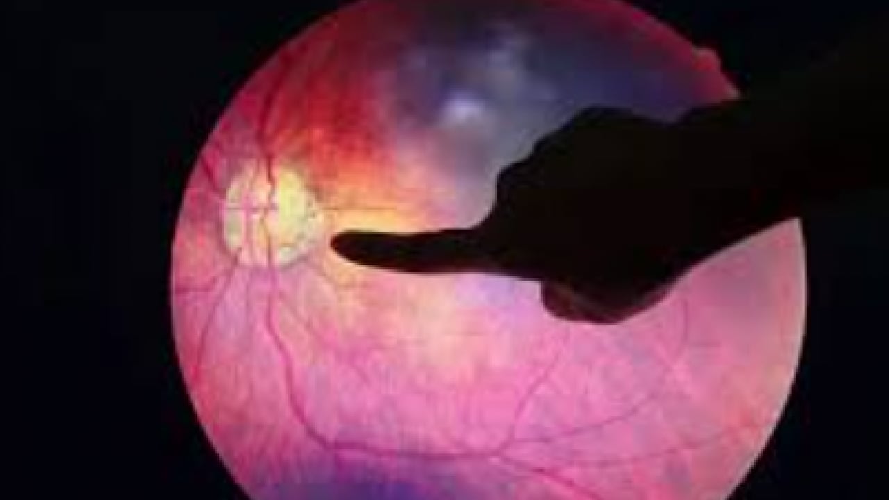 Foto - Gözün ‘sessiz hırsızı’ Glokom: Fark ettiğinizde çok geç olabilir