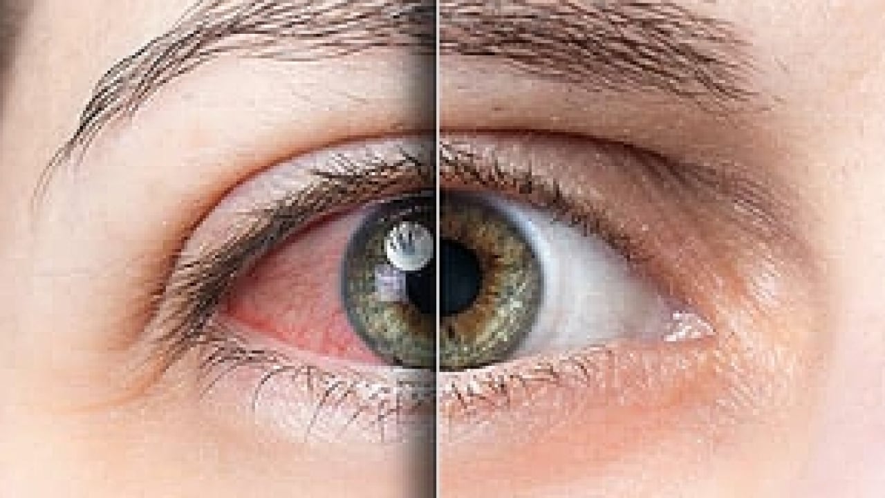 Foto - Gözün ‘sessiz hırsızı’ Glokom: Fark ettiğinizde çok geç olabilir