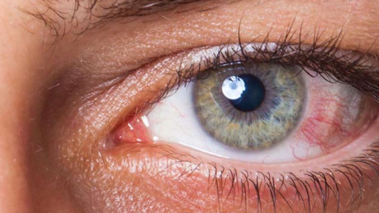 Foto - Gözün ‘sessiz hırsızı’ Glokom: Fark ettiğinizde çok geç olabilir