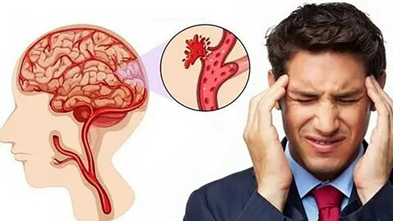 Foto - Güneşe çıkanlar dikkat! Uzman isim uyardı: Aşırı sıcaklar beyin kanamasını tetikliyor!