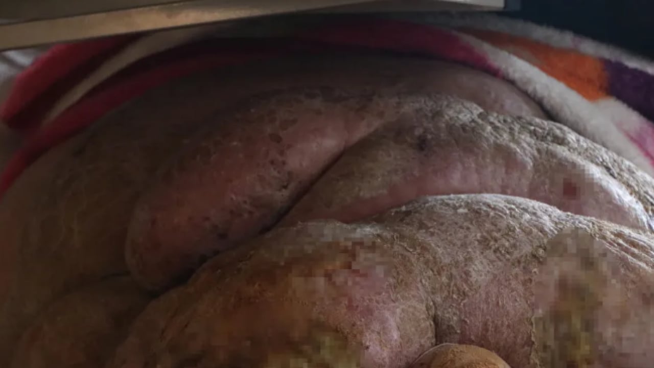 Foto - Hastalığı hayatını kararttı: 5 yıldır evden çıkamıyor!