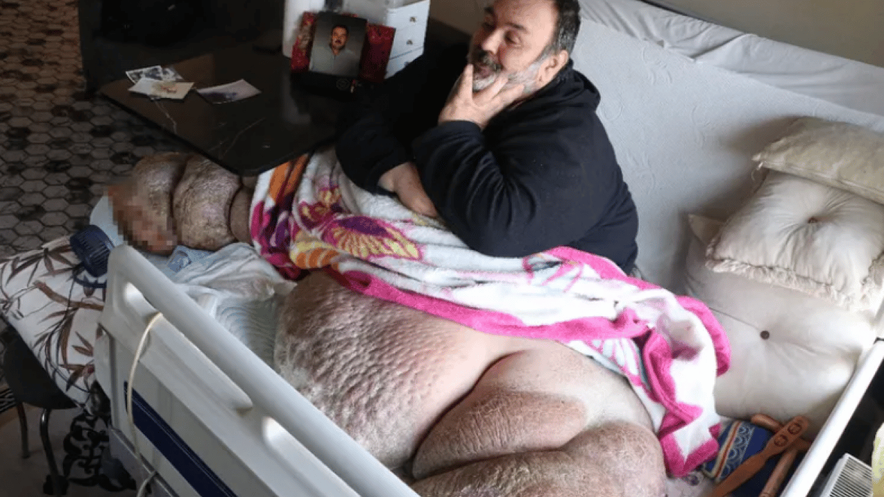 Hastalığı hayatını kararttı: 5 yıldır evden çıkamıyor!