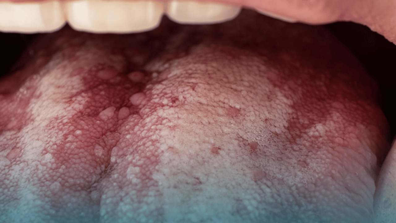 Foto - Hekimden uyarı: Ağız kuruluğu, ciddi bir sistemik hastalığın habercisi olabilir