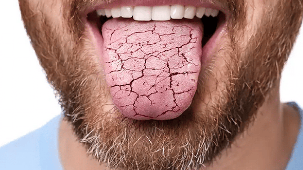 Foto - Hekimden uyarı: Ağız kuruluğu, ciddi bir sistemik hastalığın habercisi olabilir