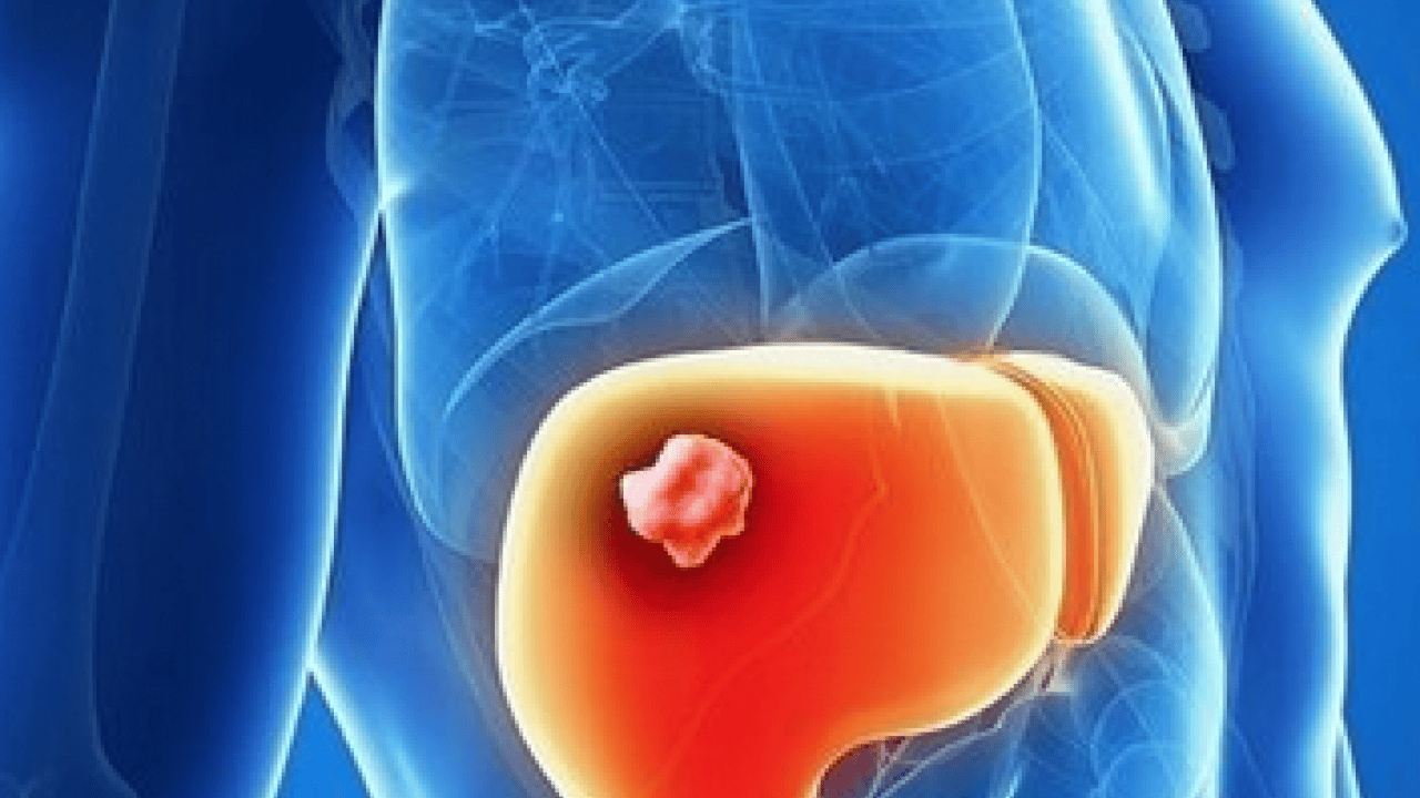 Hepatit B aşısı son derece... Karaciğer kanseri erken tanıyla kontrol altına alınabilir...