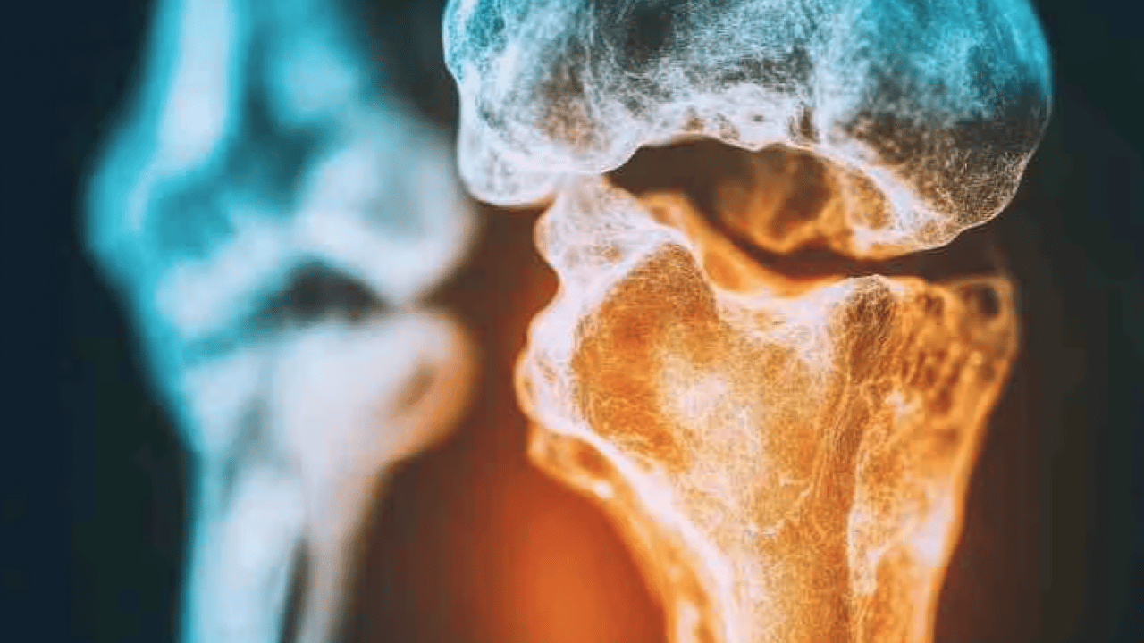 Her şeyi açıkladılar... Kemik yapısını güçlendiren o formül ortaya çıktı! 