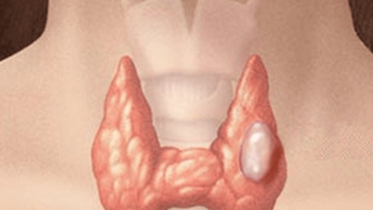 Foto - Her tiroid nodülü ameliyat gerektirmez diyerek açıkladı! Ablasyon işleminin...