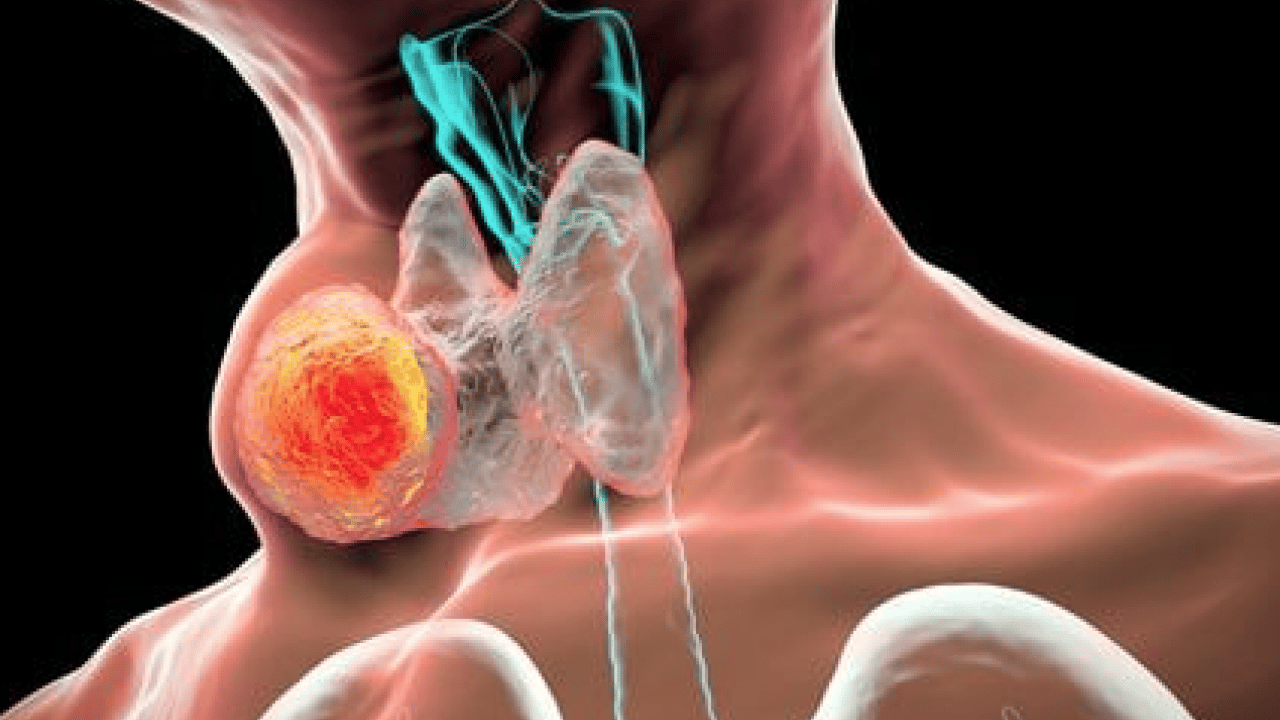 Foto - Her tiroid nodülü ameliyat gerektirmez diyerek açıkladı! Ablasyon işleminin...