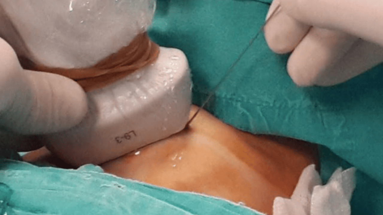 Foto - Her tiroid nodülü ameliyat gerektirmez diyerek açıkladı! Ablasyon işleminin...