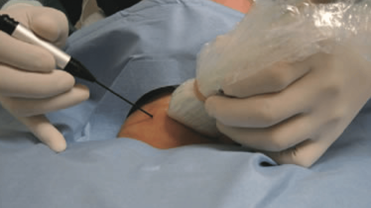 Foto - Her tiroid nodülü ameliyat gerektirmez diyerek açıkladı! Ablasyon işleminin...