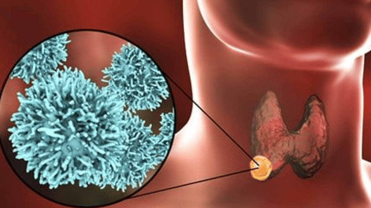 Foto - Her tiroid nodülü ameliyat gerektirmez diyerek açıkladı! Ablasyon işleminin...