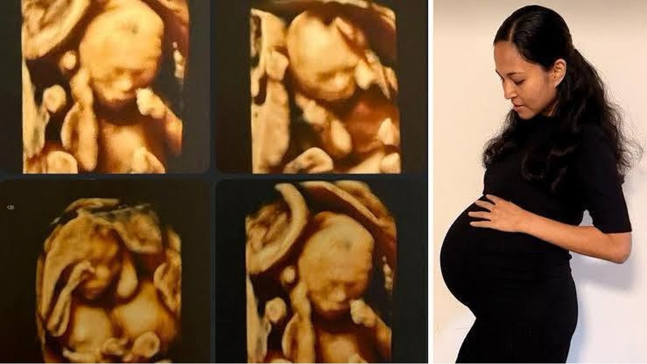 Foto - Herkes bu doğumu konuşuyor! Doktorlar bile şaşkın: 15 milyonda bir görülüyor