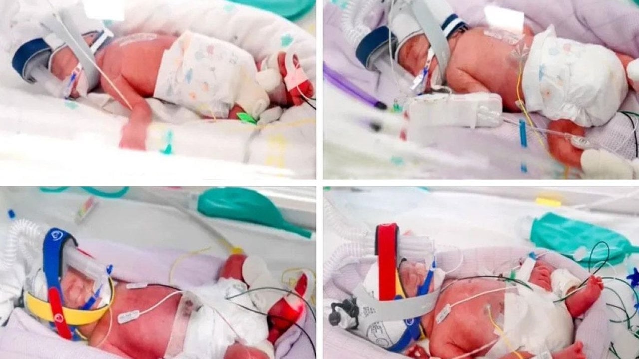Herkes bu doğumu konuşuyor! Doktorlar bile şaşkın: 15 milyonda bir görülüyor