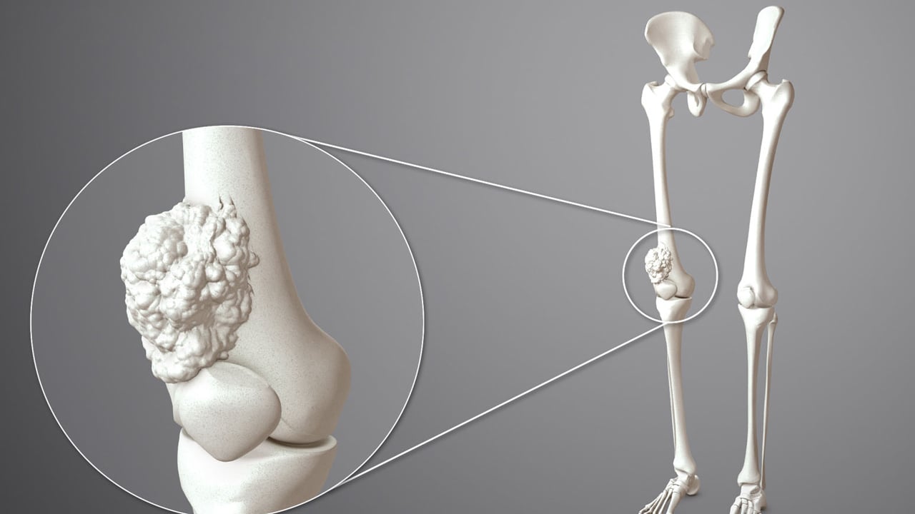 Foto - Herkesin korkulu rüyası kanser ile ilgili alkışlanacak hareket: Kanserinin agresif türünün zayıf noktası bulundu