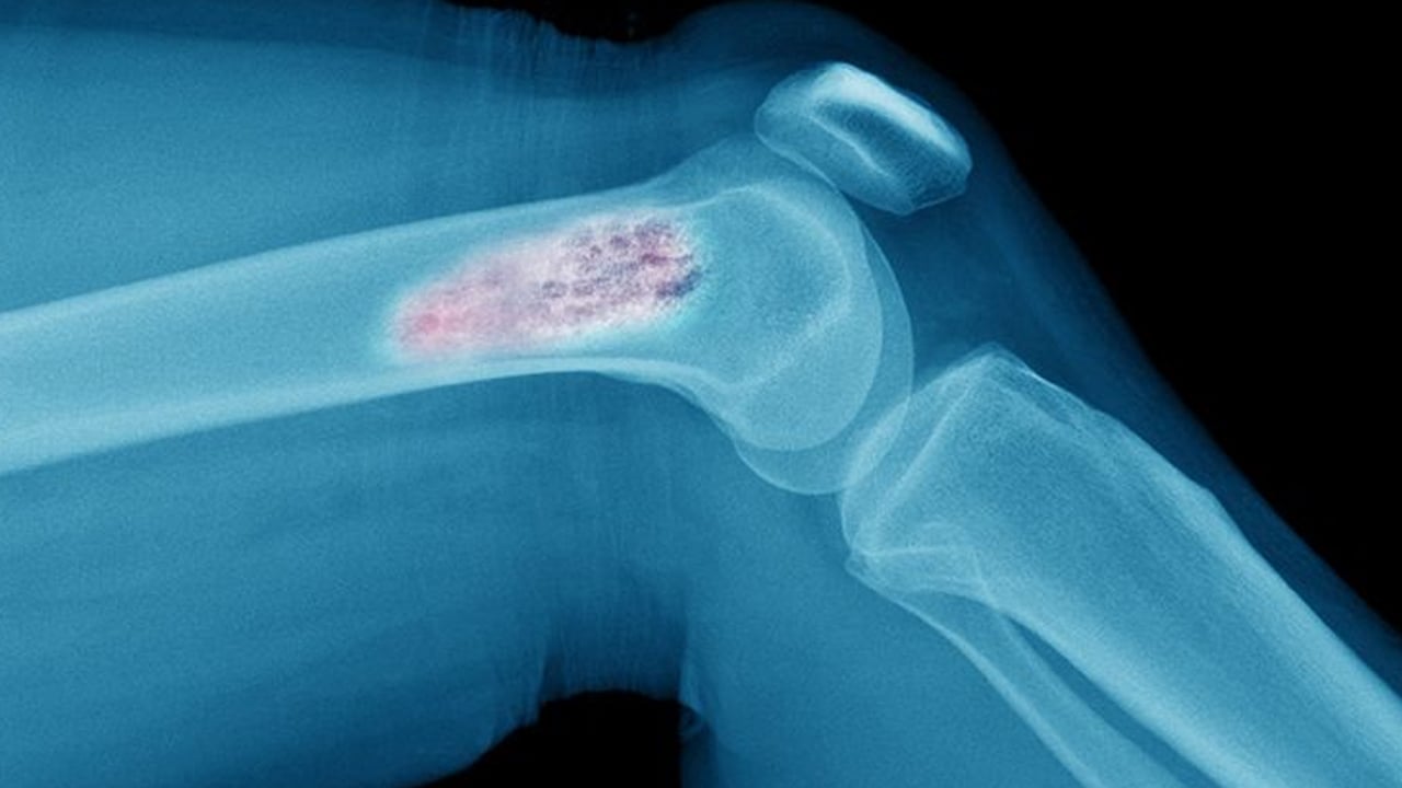 Foto - Herkesin korkulu rüyası kanser ile ilgili alkışlanacak hareket: Kanserinin agresif türünün zayıf noktası bulundu