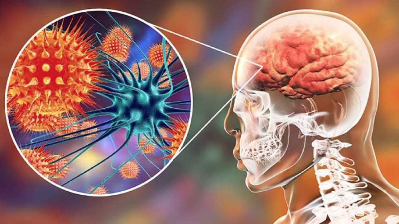 Foto - Hib, pnömokok ve meningokok aşıları... Menenjit belirtileri olan bir çocuk için her dakika kritik...