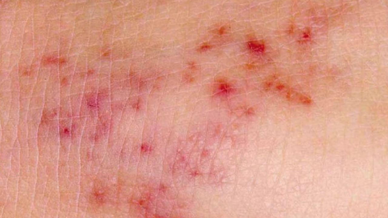 Foto - Hib, pnömokok ve meningokok aşıları... Menenjit belirtileri olan bir çocuk için her dakika kritik...